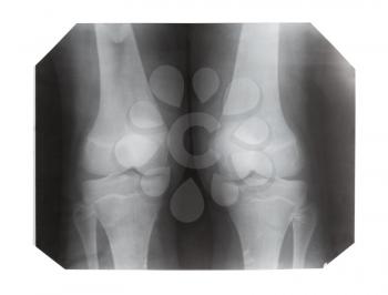 film with X-ray image of front view of two human knees isolated on white background
