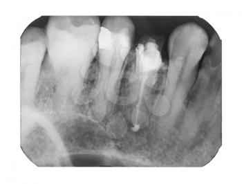 film with X-ray image of human teeth with dental pin isolated on white background