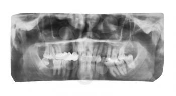 film with X-ray image of human jaws with dental crown on teeth isolated on white background