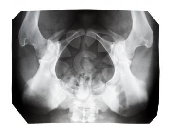 film with X-ray image of human female pelvis isolated on white background