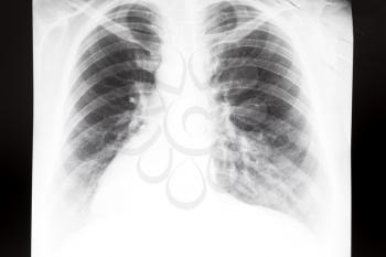 front view of human thorax with lungs on X-ray image