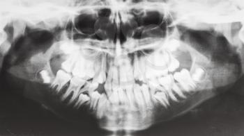 front view of human jaws on X-ray image