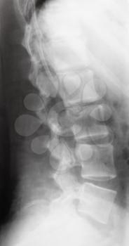side view of human spine on X-ray image