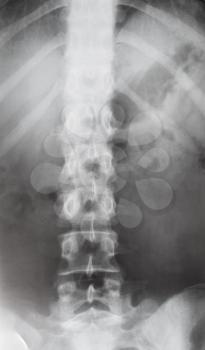 front view of human spine in torso on X-ray image