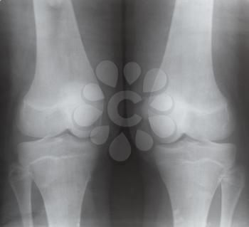 front view of two human knee joints on X-ray image