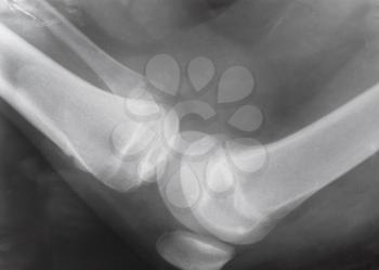 side view of human knee joint with patella on X-ray image