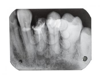 film with X-ray image of human teeth with dental pin close up isolated on white background