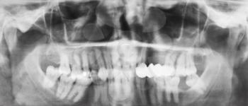 front view of human jaws with dental crown on teeth on X-ray image