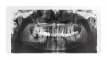 film with X-ray image of human jaws with dental crown and pins in teeth isolated on white background