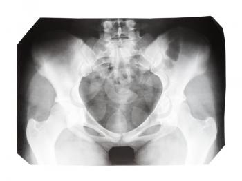 film with X-ray image of front view of human female pelvis isolated on white background