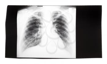 film with X-ray image of front view of human thorax isolated on white background
