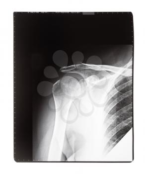 film with X-ray image of front view of human shoulder joint isolated on white background