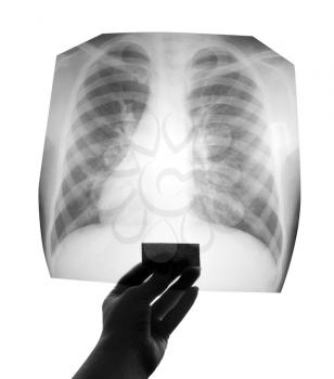 Chest X-ray image in hand