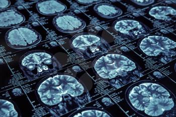 Closeup of X-ray photography of human brain 