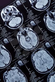 Magnetic resonance imaging photography of human brain closeup