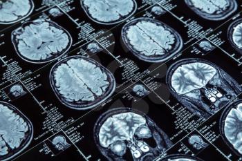Closeup of magnetic resonance imaging photography of human brain 