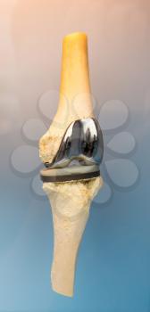 Human joint prosthesis , metal implant. Surgical prosthetic technology, medical engineering