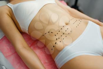Female patient with markers on her abdomen lying on treatment table in cosmetician's office. Rejuvenation procedure in beautician salon. Cosmetic surgery against wrinkles, botox