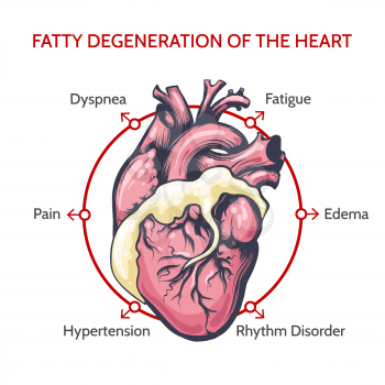 Fatty Degeneration of the Heart. Main Symptoms of desease. Medical cardiology vector illustration.