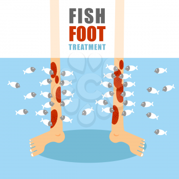 Treatment foot fish. Medical procedure for treatment of psoriasis and skin diseases. Small fish eat painful human skin. Lower limbs standing in water with marine animals.

