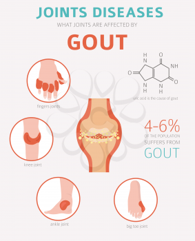 Joints diseases. Gout symptoms, treatment icon set. Medical infographic design. Vector illustration