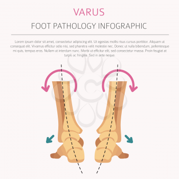 Foot deformation as medical desease infographic. Valgus and varus defect. Vector illustration