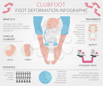 Foot deformation, medical desease infographic. Clubfoot defect. Vector illustration