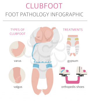 Foot deformation, medical desease infographic. Clubfoot defect. Vector illustration