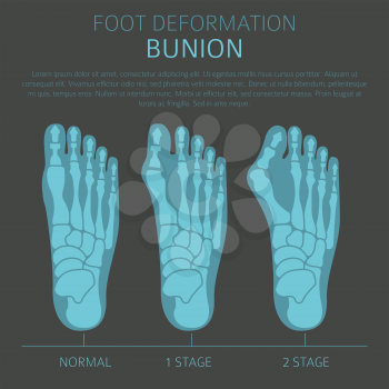 Foot deformation as medical desease infographic. Causes of bunion. Vector illustration
