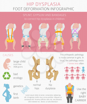 Foot deformation types,  medical desease infographic. Hip dysplasia in children. Vector illustration