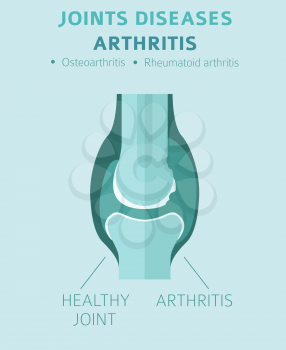 Joints diseases. Arthritis symptoms, treatment icon set. Medical infographic design.  Vector illustration