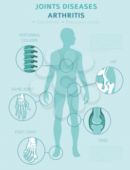 Joints diseases. Arthritis symptoms, treatment icon set. Medical infographic design.  Vector illustration