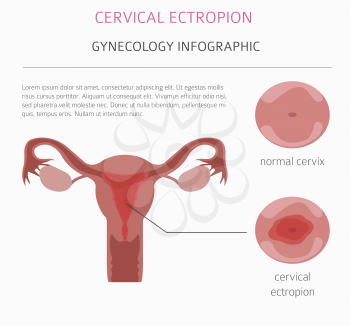 Cervical ectropion. Ginecological medical desease infographic. Vector illustration