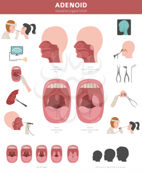 Nasal and throat, nasopharynx diseases. Adenoids diagnosis and treatment medical infographic design. Vector illustration