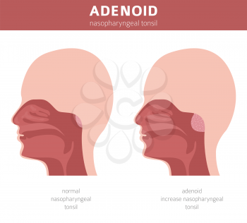 Nasal and throat, nasopharynx diseases. Adenoids diagnosis and treatment medical infographic design. Vector illustration
