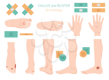 Callus, corn and blister feet and hands. Dermatology. Medical desease infographics collection. Vector illustration