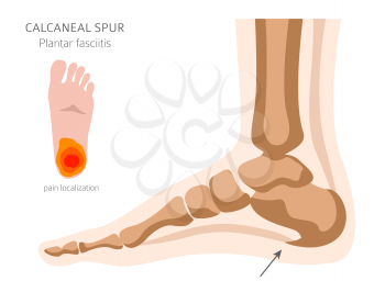 Calcaneal spur. Plantar fasciitis set. Medical desease infographics collection. Vector illustration