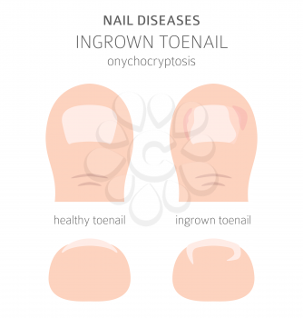 Nail diseases. Onychocryptocosis, ingrown toenail. Medical infographic design.  Vector illustration