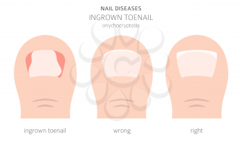 Nail diseases. Onychocryptocosis, ingrown toenail. Medical infographic design.  Vector illustration