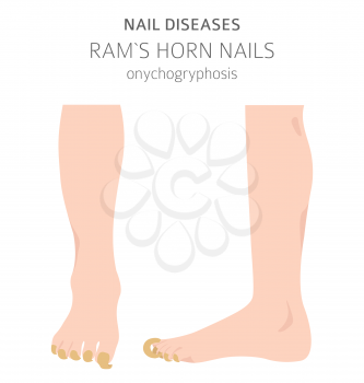Nail diseases. Onychogryphosis, Ram`s horn nail. Medical infographic design.  Vector illustration