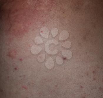 Allergy skin back and sides. Allergic reactions on the skin in the form of swelling and redness.