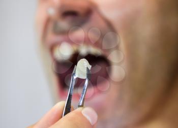 Dental prosthesis of metal ceramics in tweezers. A patient without a tooth is trying on a denture. Tooth implantation, dental treatment.