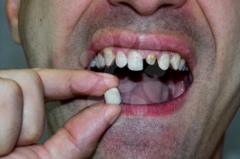 Dental prosthesis of metal ceramics in the hand of a man without a tooth. A patient without a tooth is trying on a denture. Tooth implantation, dental treatment.