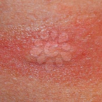 Allergy skin. Allergic reactions on the skin in the form of swelling and redness.