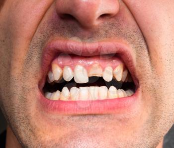 Broken tooth. Broken upper incisor in a man mouth. Man shows oral cavity to the dentist. Treatment of a broken tooth.