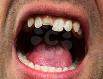 Broken tooth. Broken upper incisor in a man mouth. Man shows oral cavity to the dentist. Treatment of a broken tooth.