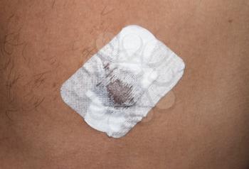 Bactericidal adhesive tape on the male nipple. Dressing after surgery on the nipple areola.