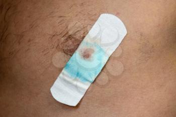 Bactericidal adhesive tape on the male nipple. Dressing after surgery on the nipple areola.