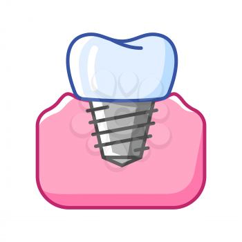 Illustration of dental implant. Dentistry and health care icon. Stomatology and medical item.