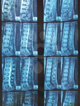 X-ray image of a human adult backbone. Medicine design.